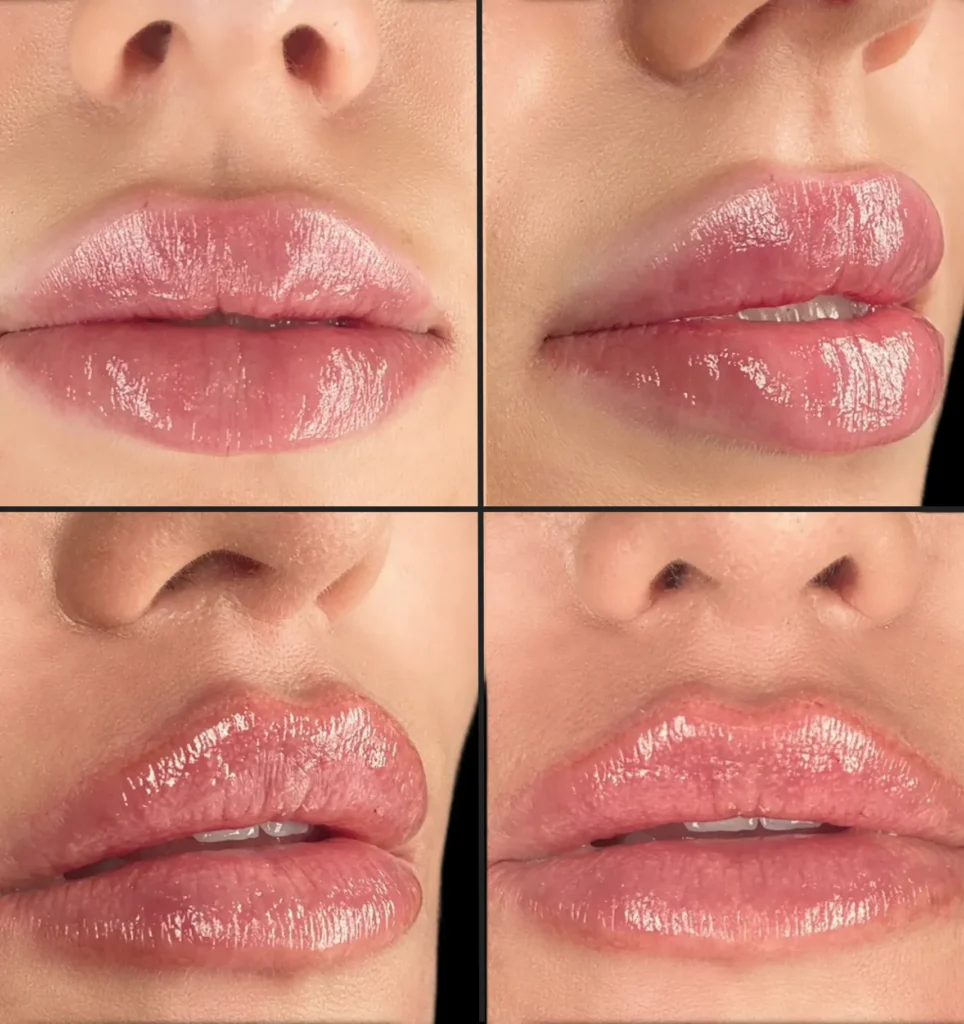 Ile ml kwasu do ust? 0,5 ml vs 1 ml