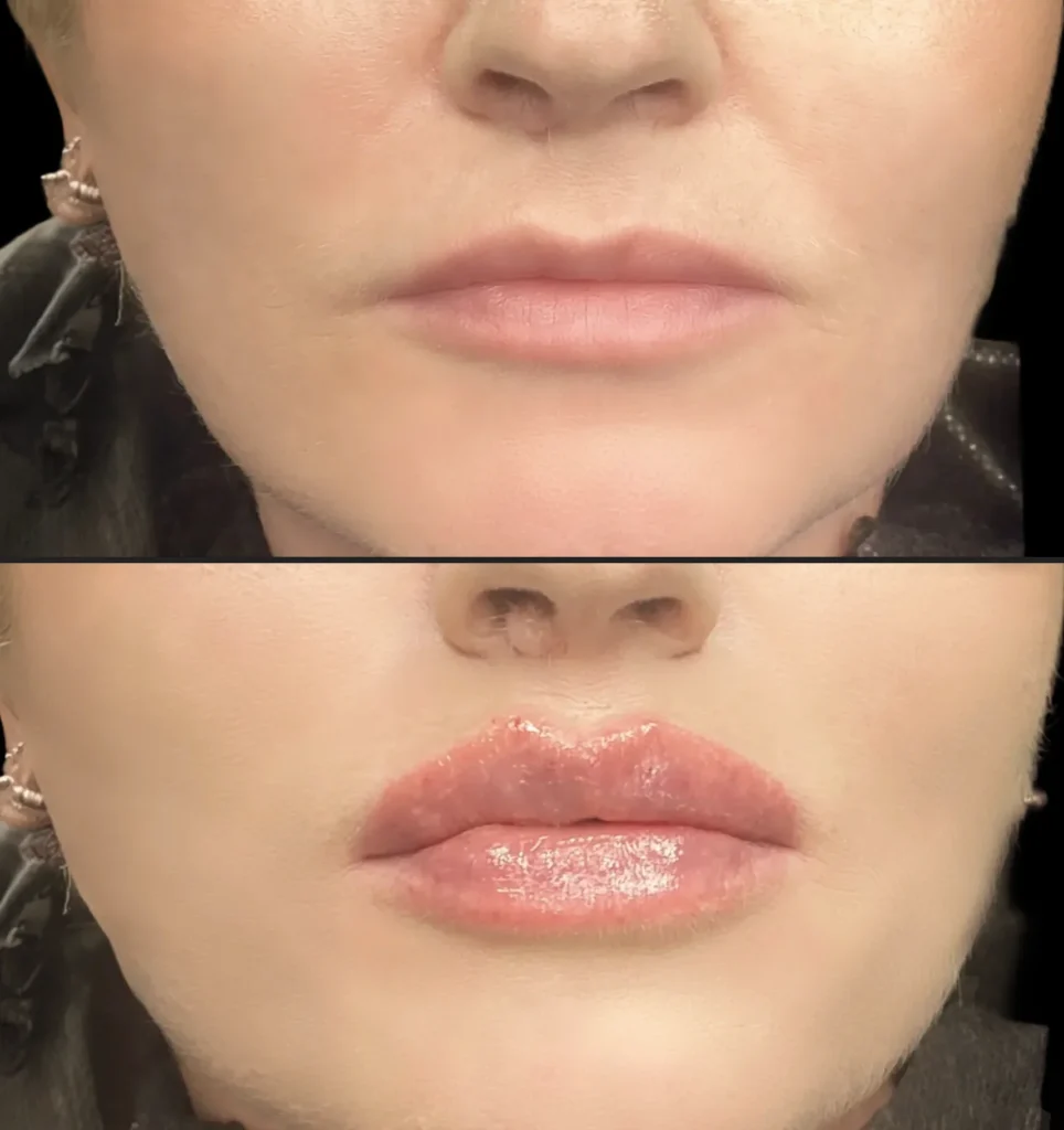 modelowanie ust wrocław