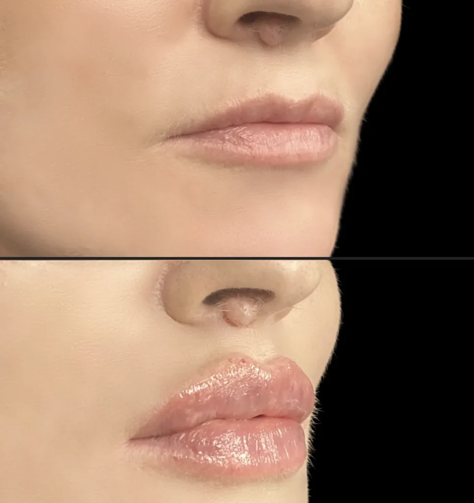 Czy powiększanie ust boli? Jak wygląda zabieg krok po kroku | ILLUSTRE Wrocław