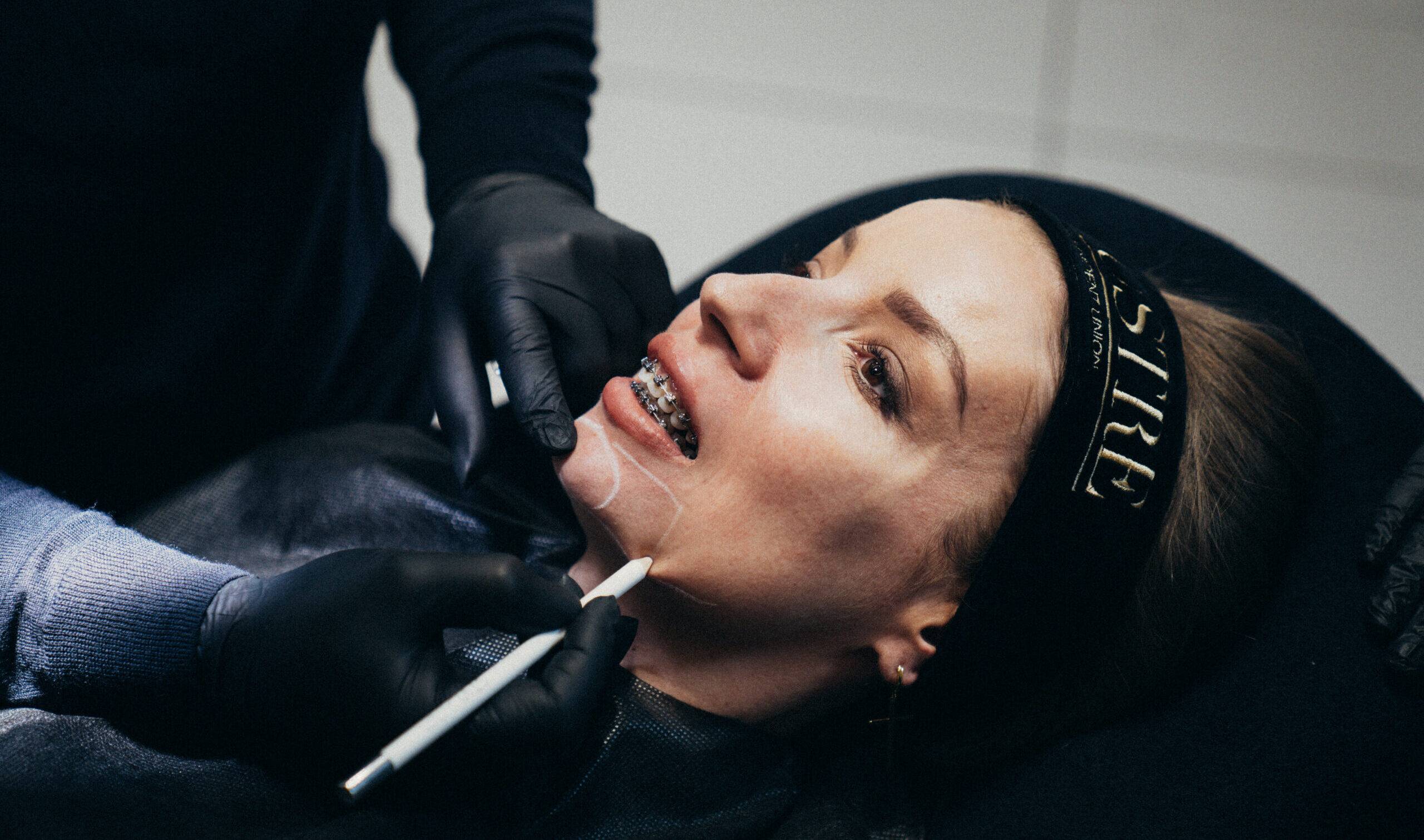 Wolumetria bródki, brody oraz linii i kąta żuchwy kwasem hialuronowym