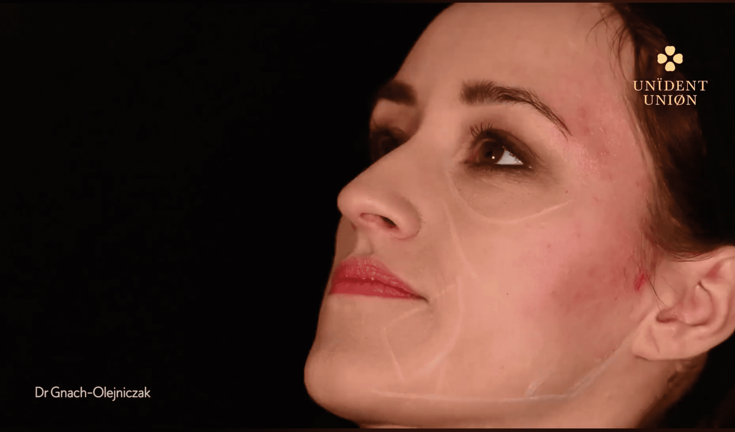 Wolumetria całej twarzy kwasem hialuronowym