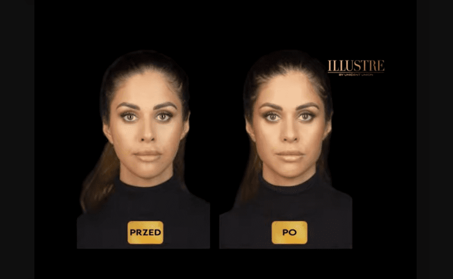 Modelowanie brody, linii żuchwy i kąta żuchwy kwasem hialuronowym