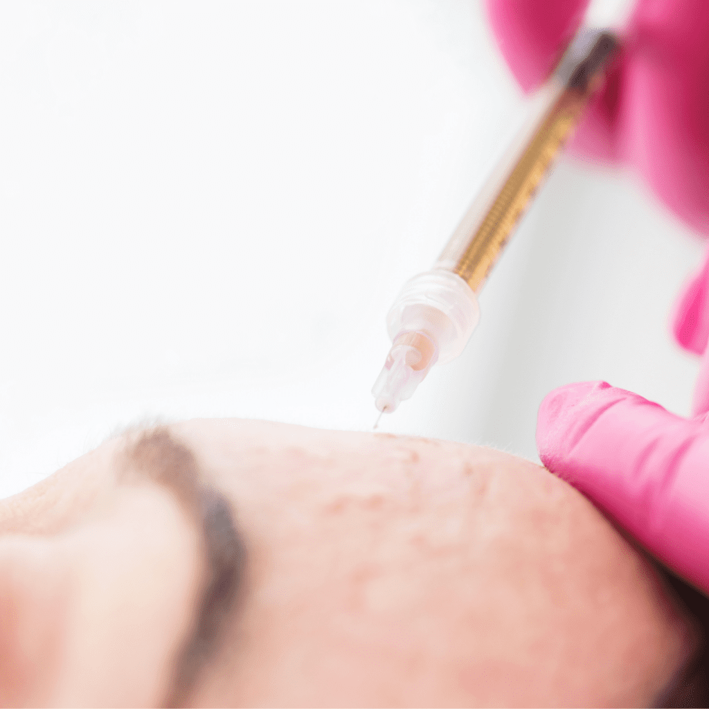 mezoterapia igłowa Wrocław Jak często robić mezoterapię igłową – indywidualny plan zabiegowy w Klinice Illustre we Wrocławiu