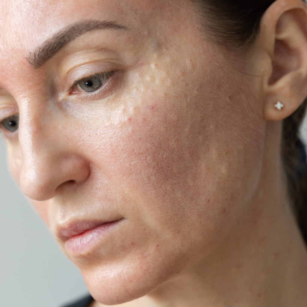 Mezoterapia – co to jest i czy boli? Ilustre Wrocław