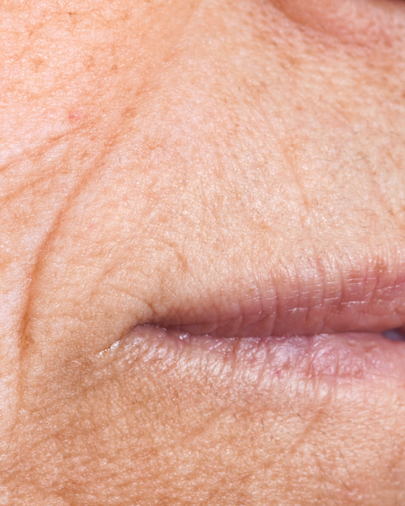 Zmarszczki wokół ust? Sprawdź, jak odmłodzić usta bez przerysowania. Biostymulacja, laser i naturalne modelowanie ust – ILLUSTRE Wrocław.